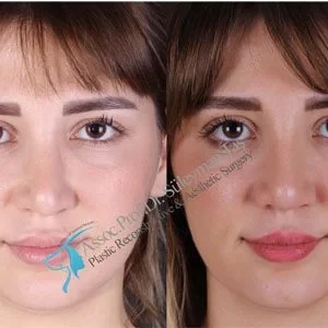 Dr Suleyman Tas Natural Revision Rhinoplasty