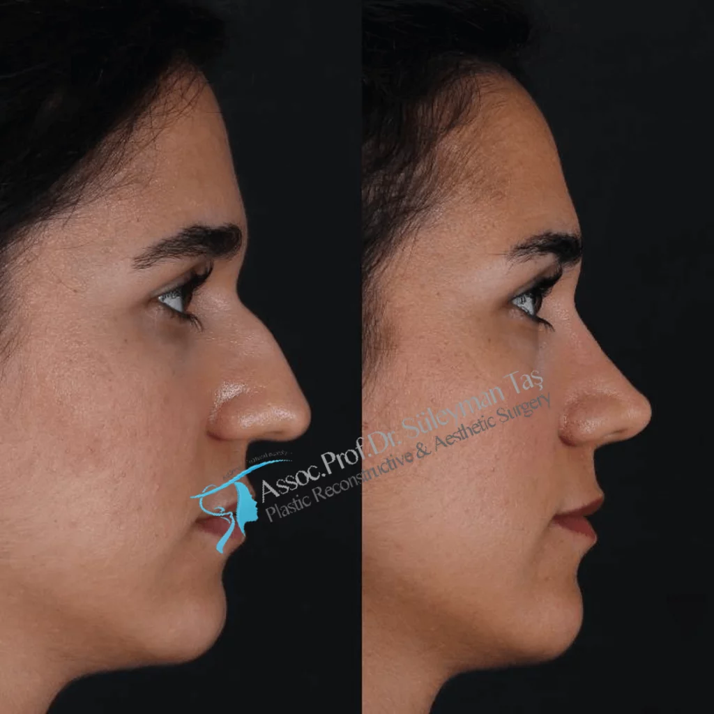 Suleyman Tas Before After Rhinoplasty