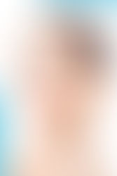 How a Rhinoplasty Can Help a Deviated Septum?