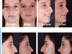 Rhinoplasty Experience