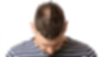 Before-and-After-Hair-Transplant.jpg