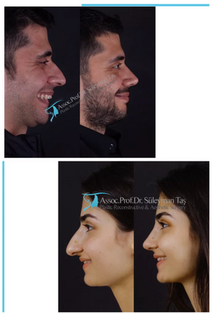 Male Rhinoplasty vs. Female Rhinoplasty