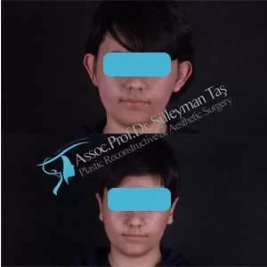 facelift-necklift-foxeyes-ear-surgery-before-and-after-gallery-11.webp