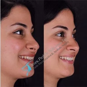 Revision Rhinoplasty Turkey Results