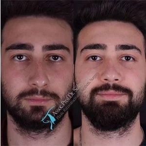 Dr Suleyman Tas Male Rhinoplasty Side Profile