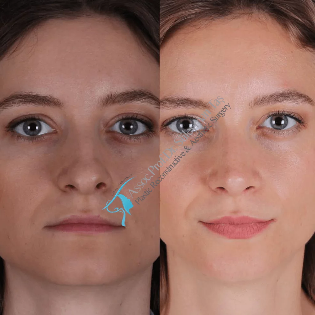 Suleyman Tas Before After Rhinoplasty