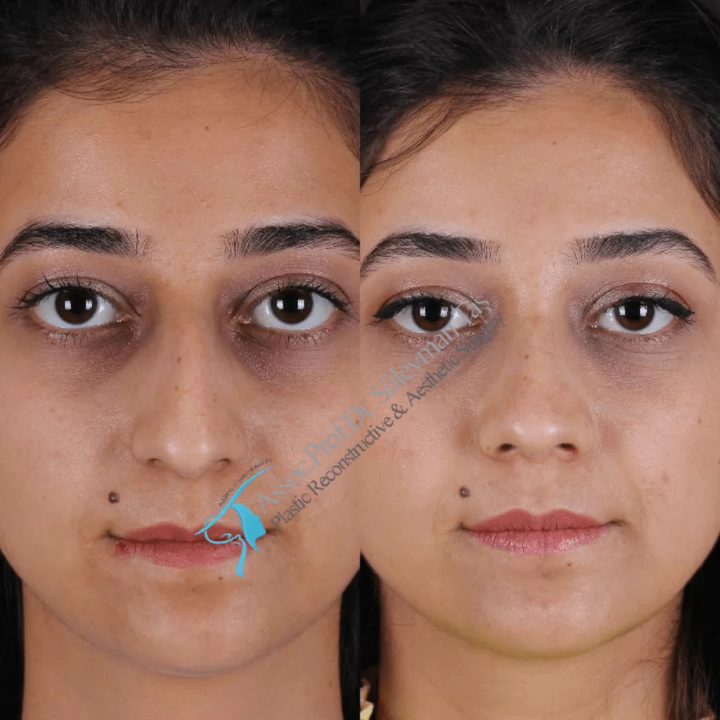 Suleyman Tas Before After Rhinoplasty