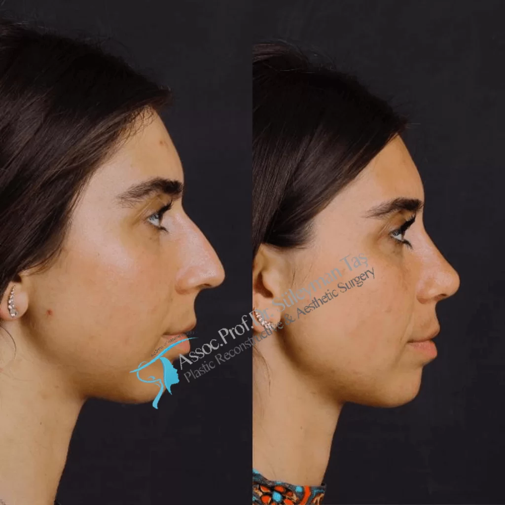 Suleyman Tas Before After Rhinoplasty
