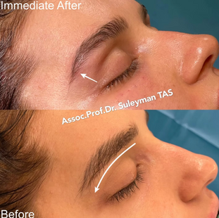 Fox eyes brow lift eyebrow before and after photo by Prof. Dr. Suleyman Tas