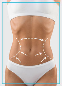 Liposuction for Love Handles