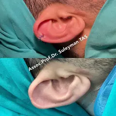 Case Study Number 20 – Otoplasty