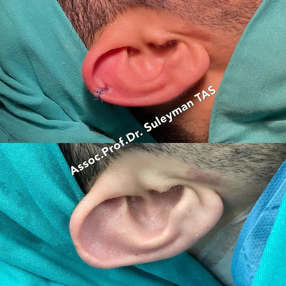 Case Study Number 20 – Otoplasty