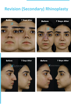 Causes and Consequences of Failed Rhinoplasty