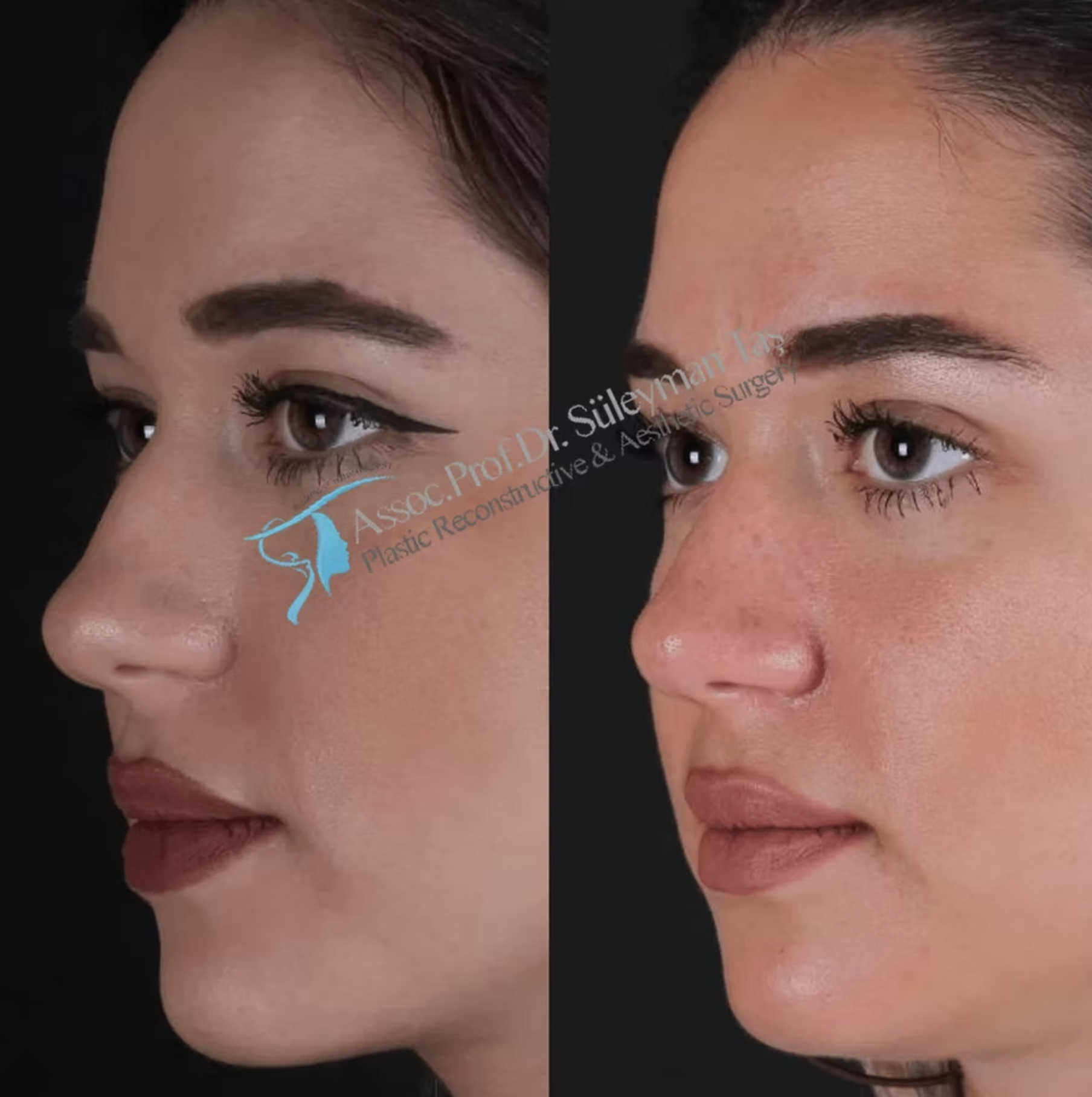 Suleyman Tas Ultrasonic Rhinoplasty Turkey