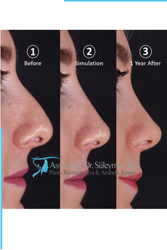 Simulation In Rhinoplasty