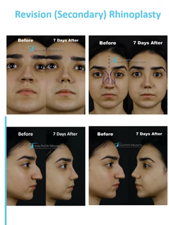Causes and Consequences of Failed Rhinoplasty Suleyman Tas