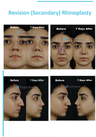 Causes and Consequences of Failed Rhinoplasty Suleyman Tas