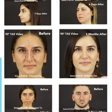 Before Rhinoplasty