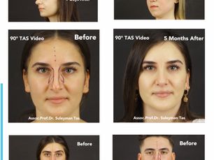 Prof Dr Suleyman Tas Before After