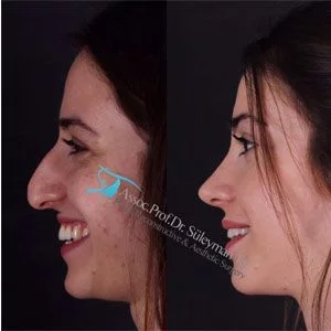 Suleyman Tas Before After Rhinoplasty