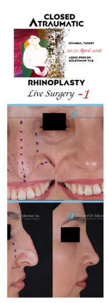 Prof.Dr. Suleyman TAS Closed Atraumatic Rhinoplasty Live Surgery DVD 1 / Digital