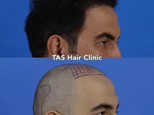 Case Study – Hair Transplant
