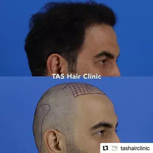 Case Study – Hair Transplant