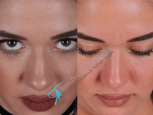 Suleyman Tas Nose Job Before After Results