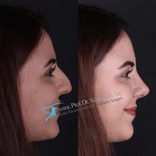 Suleyman Tas natural nose job results
