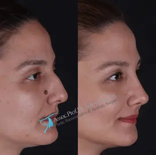 Suleyman Tas ethnic rhinoplasty before after