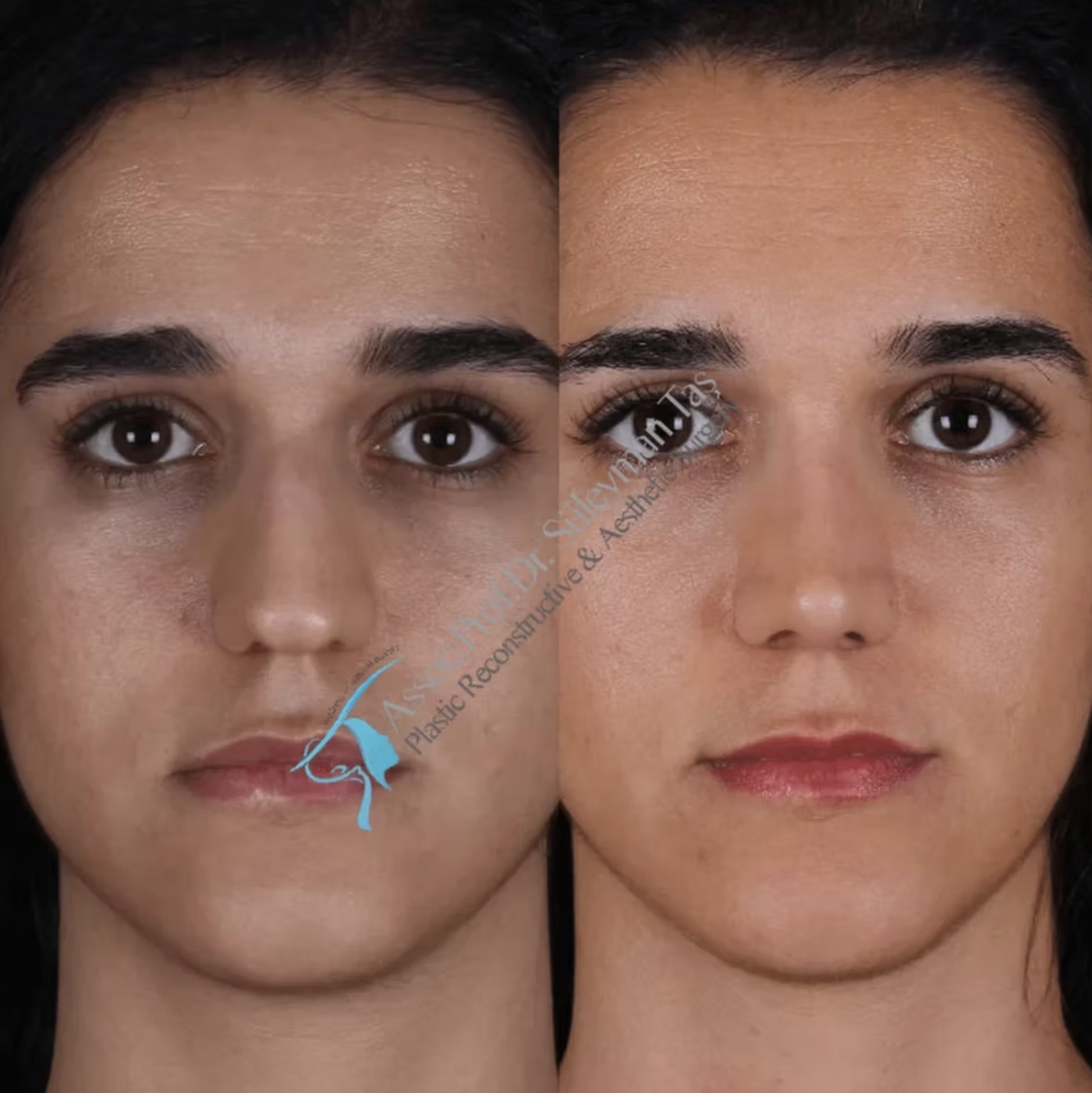 Suleyman Tas Before After Nose Surgery Results