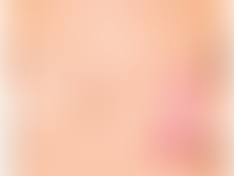 Breast Reconstruction After Breast Cancer