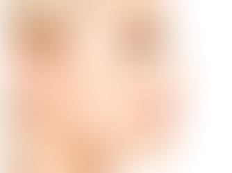 What is the nasal collapse? How can it be addressed?