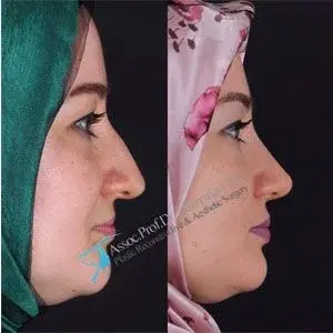Suleyman Tas high definition rhinoplasty