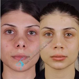 Female Revision Rhinoplasty Turkey Dr Suleyman Tas