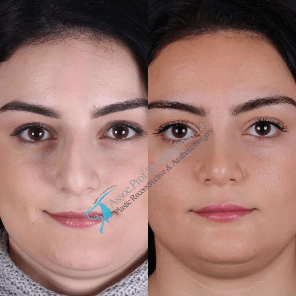 Suleyman Tas Before After Rhinoplasty