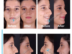 Rhinoplasty Experience
