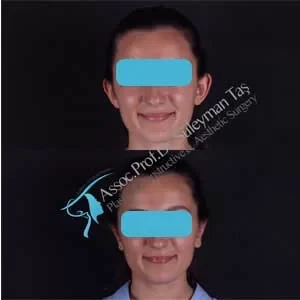 facelift-necklift-foxeyes-ear-surgery-before-and-after-gallery-19.webp