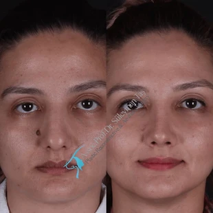 Suleyman Tas revision rhinoplasty before after