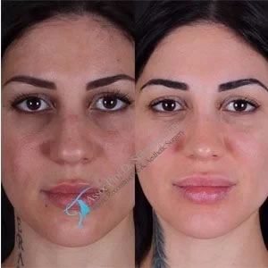 Female Revision Rhinoplasty Gallery