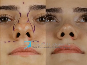 Suleyman Tas Rhinoplasty Before After – Natural Nose Surgery Results