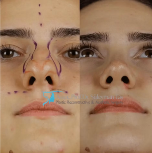 Suleyman Tas Rhinoplasty Before After – Natural Nose Surgery Results
