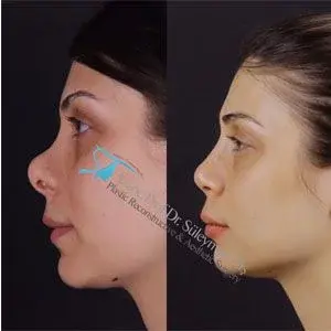 Dr Suleyman Tas Secondary Nose Surgery Results