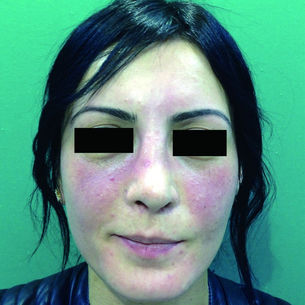 Severe Facial Dermatitis Following Rhinoplasty due to an Unusual Etiopathogenesis: Rosacea — Prof. Dr. Suleyman TAS