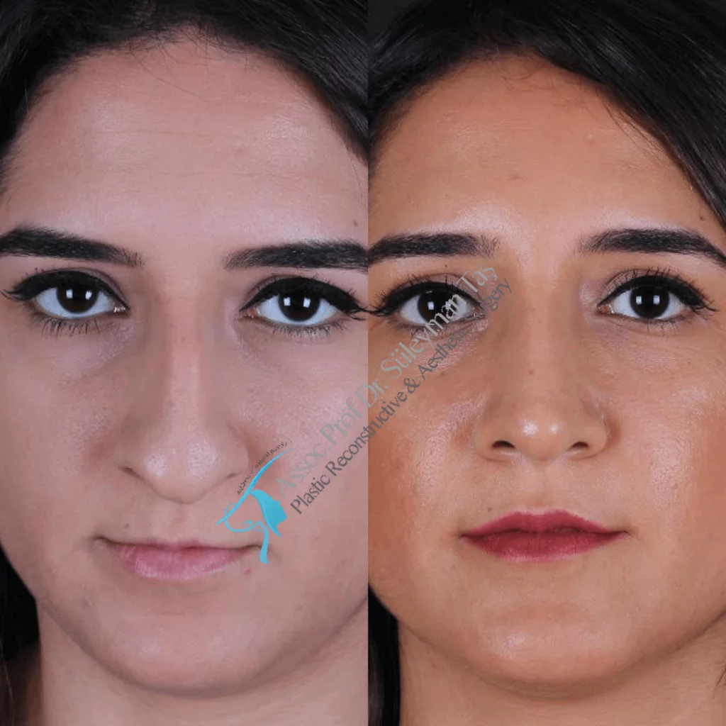 Suleyman Tas Before After Rhinoplasty