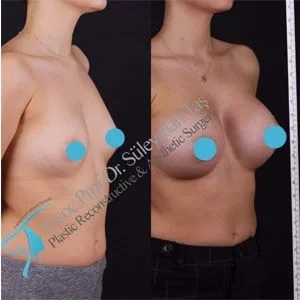 Breast augmentation before after result by Prof.Dr. Suleyman TAS with natural breast shape and balanced volume.