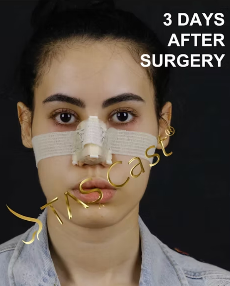 Suleyman Tas Nose Cast .jpeg
