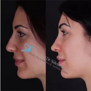 Dr Suleyman Tas Advanced Revision Rhinoplasty