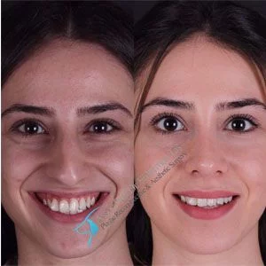 Suleyman Tas Before After Rhinoplasty