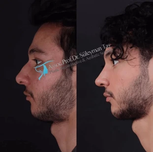 Dr Suleyman Tas Male Nose Profile Before After